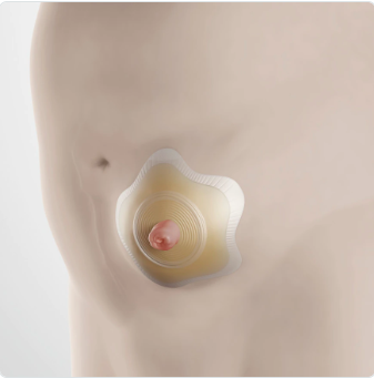 Produktbild der Sensura Click Basisplatte, konvex, mit Durchmesser von 50 mm und einer Öffnung von 25 mm. Die Basisplatte hat eine glatte, hautfarbene Oberfläche und ist mit einem Kleberand versehen, der für sicheren Halt auf der Haut sorgt. Die zentrale Öffnung ist kreisförmig und bietet Platz für den Stoma-Ausgang. Die Platte ist so gestaltet, dass sie bequem auf der Haut sitzt und eine gute Anpassung an den Körper ermöglicht.